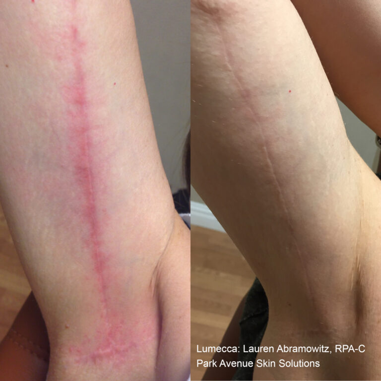 Lumecca before and after image of a clients interior upper arm with surgical scar.