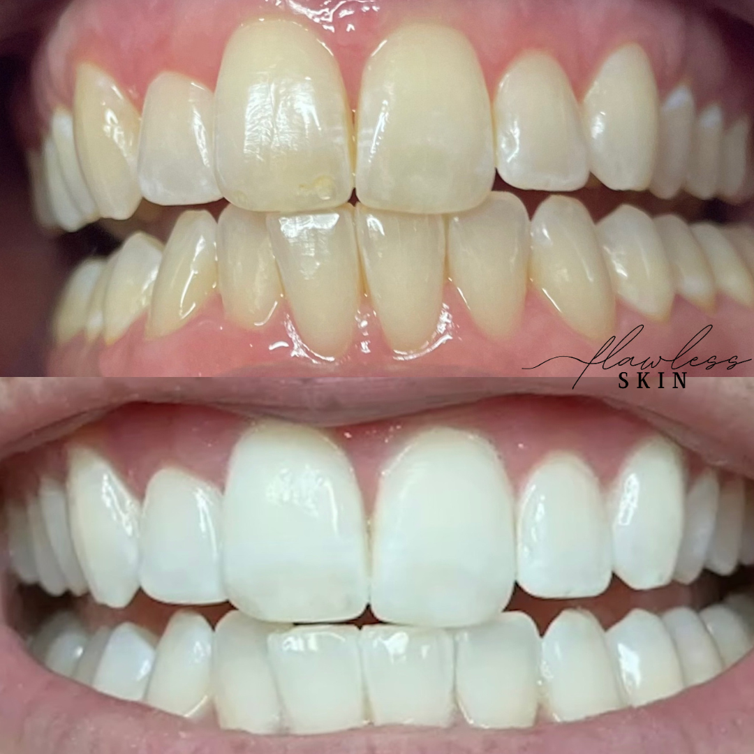 Teeth Whitening Before and after