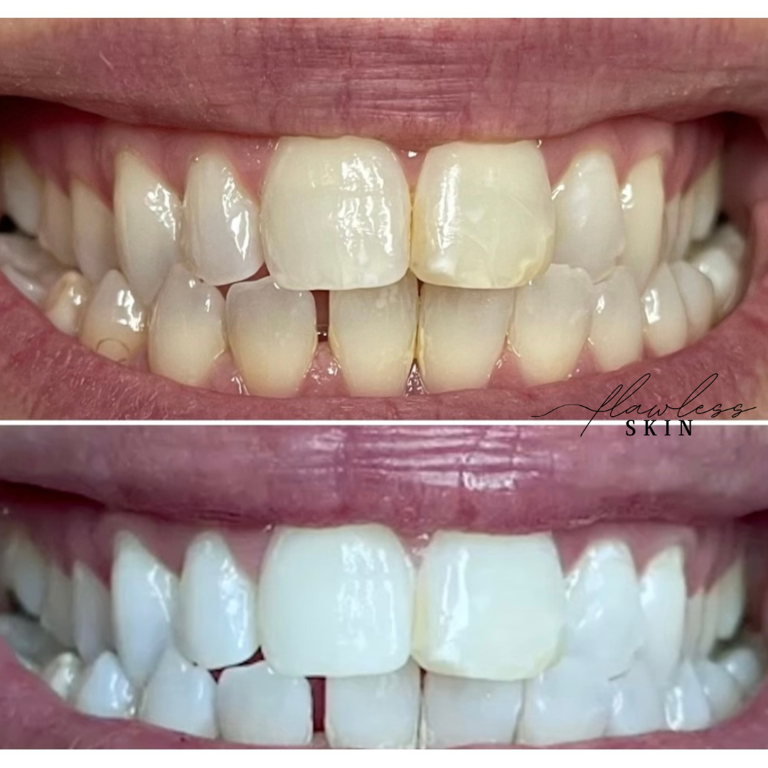 Teeth Whitening Before and after