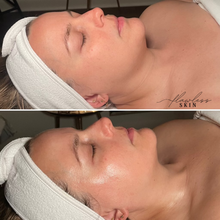 Trinity Hydrodermabrasion Facial before and after of client