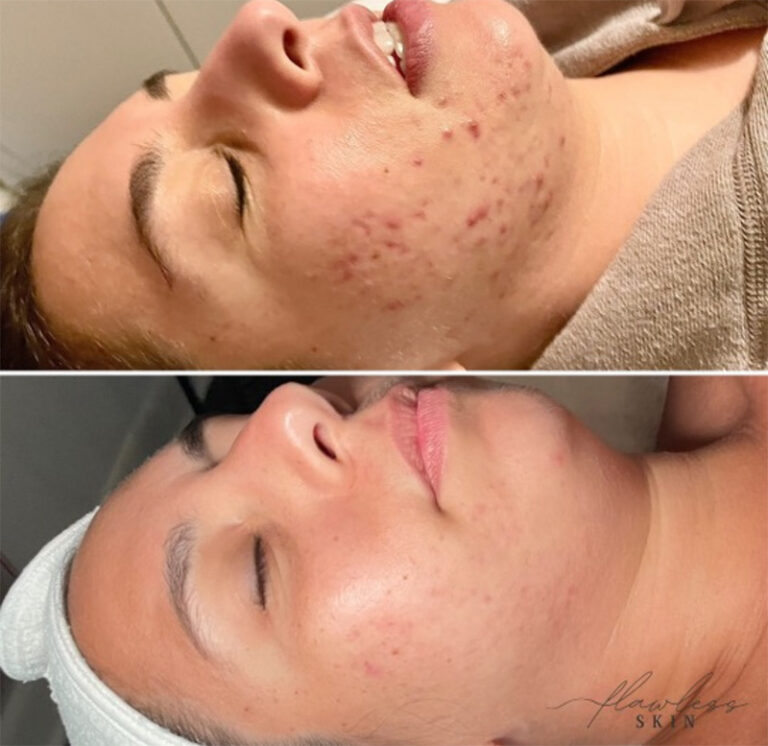 Acne peel with SkinPen before and after