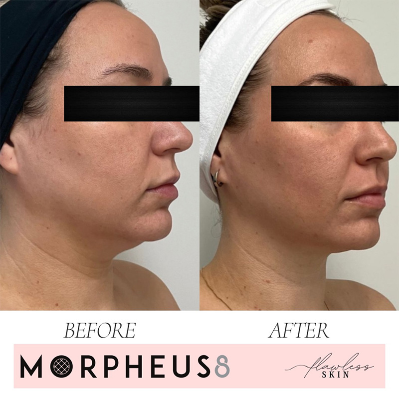 Morpheus8 before and after images