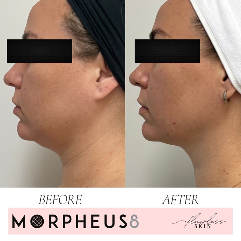 Morpheus8 before and after images