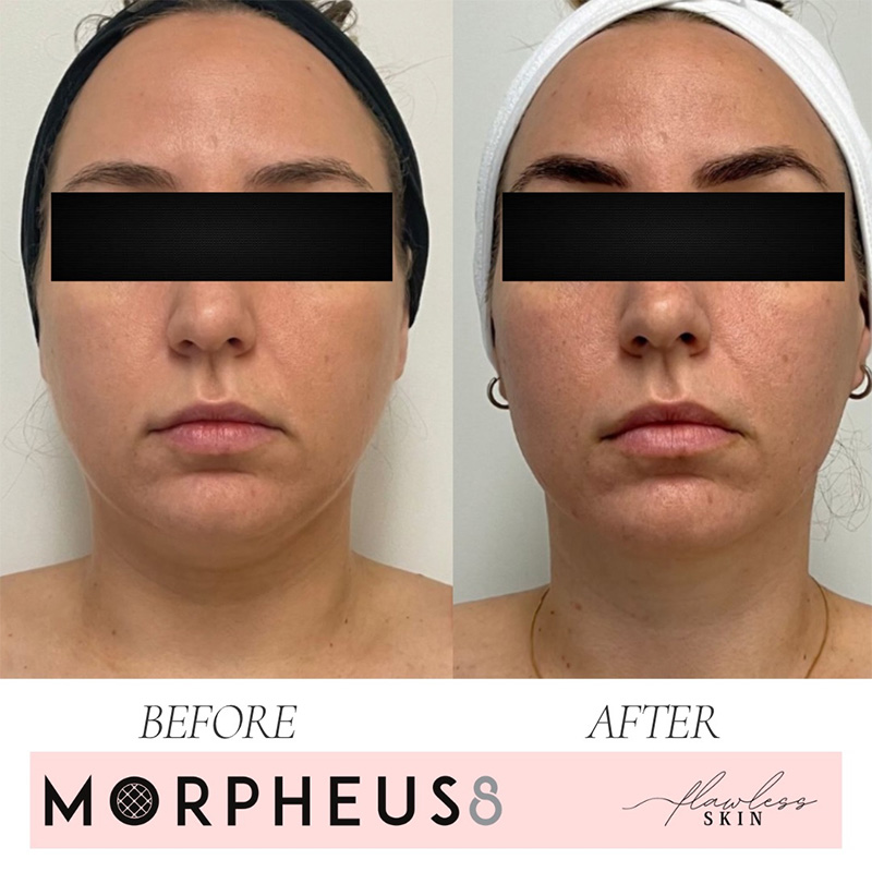 Morpheus8 before and after images