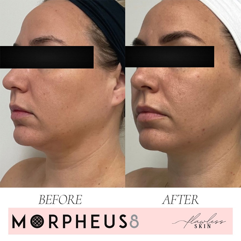 Morpheus8 before and after images