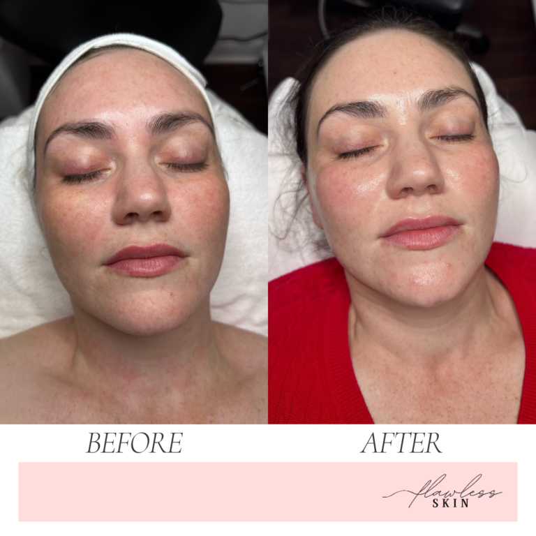 esthetician performing a Dermaplane facial for a client