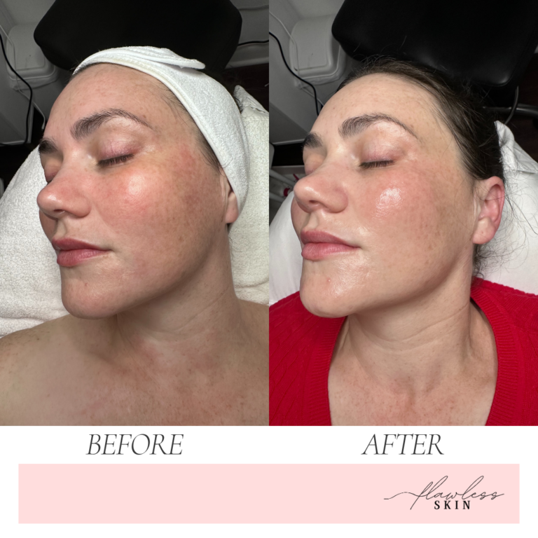 esthetician performing a Dermaplane facial for a client