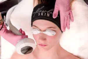 A client of Flawless Skin is getting a Lumecca IPL treatment 